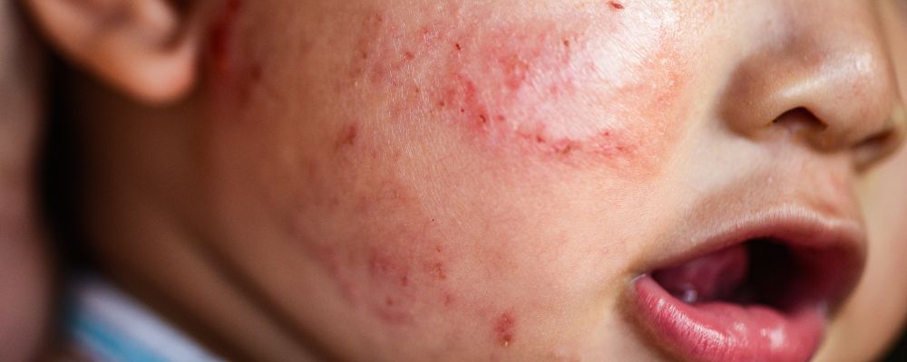 Common Skin Rashes in Newborns