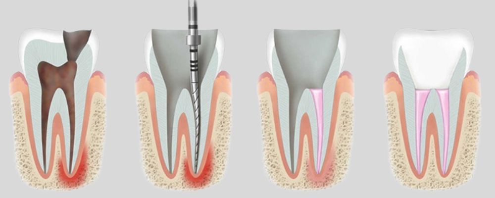 Root Canal Treatment Procedure